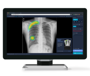 Conheça o Lunit INSIGHT CXR e sua importância nas radiografias torácicas