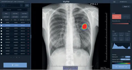 Tudo o que você precisa saber sobre o VUNO Med-Chest X-ray